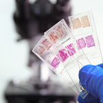 ffpe tissue sample for biomarker discovery